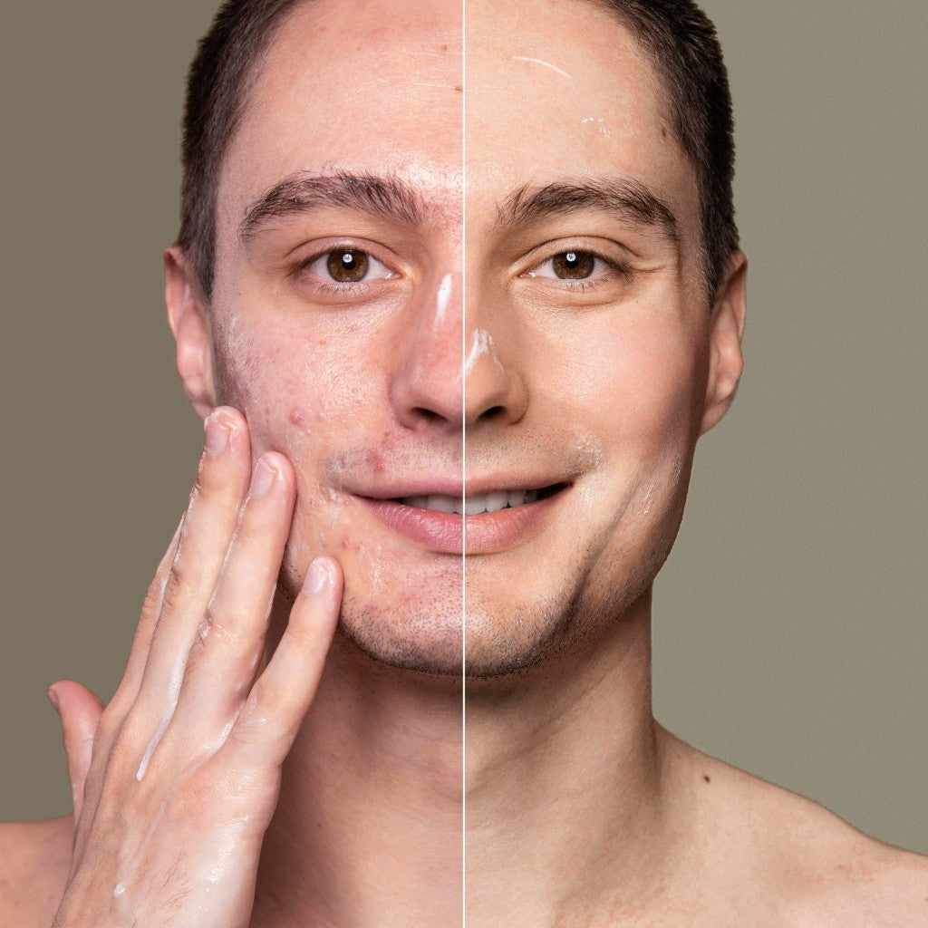 Before and after comparison of a man's face with visible skin treatment with maysense ph balancing face wash.